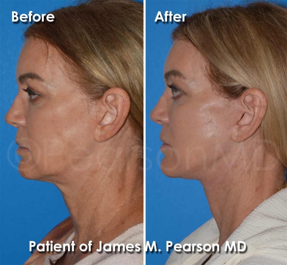 Dr. Pearson Plastic Surgeon