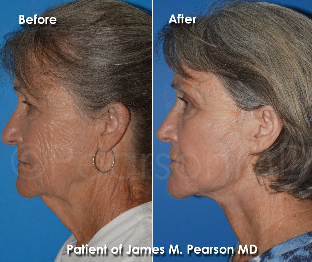 Dr. Pearson Plastic Surgeon