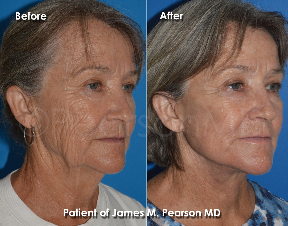 Pearson Plastic Surgery