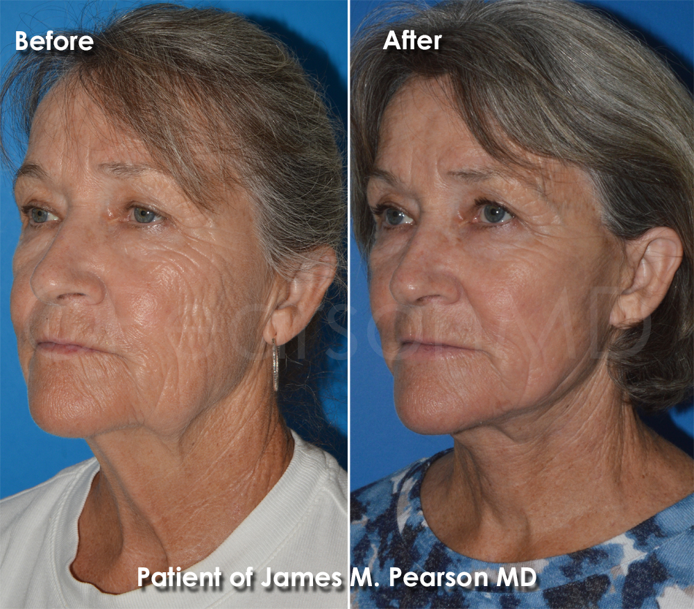 Pearson Plastic Surgery