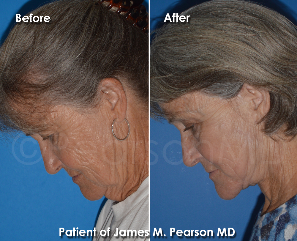 Pearson Plastic Surgery