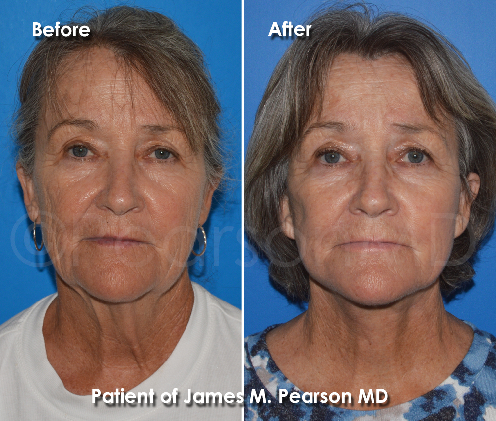Pearson Plastic Surgery