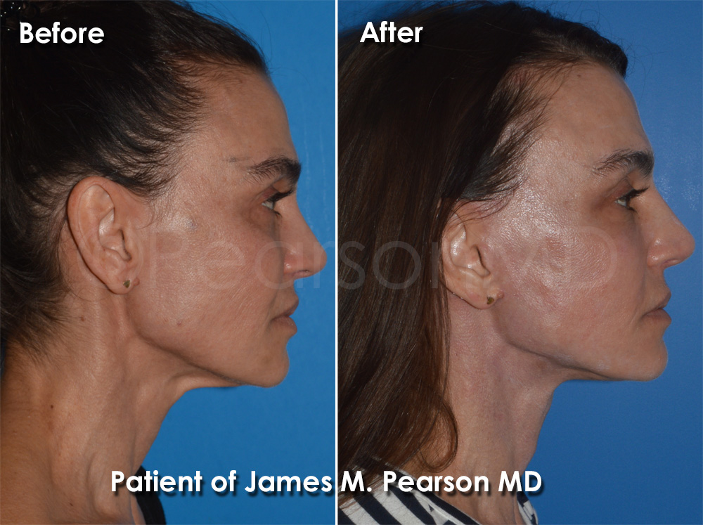 Dr. Pearson Plastic Surgeon