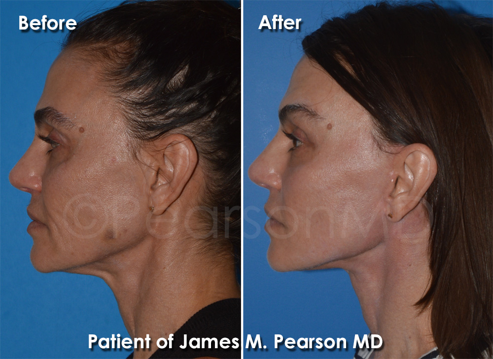 Pearson Plastic Surgery