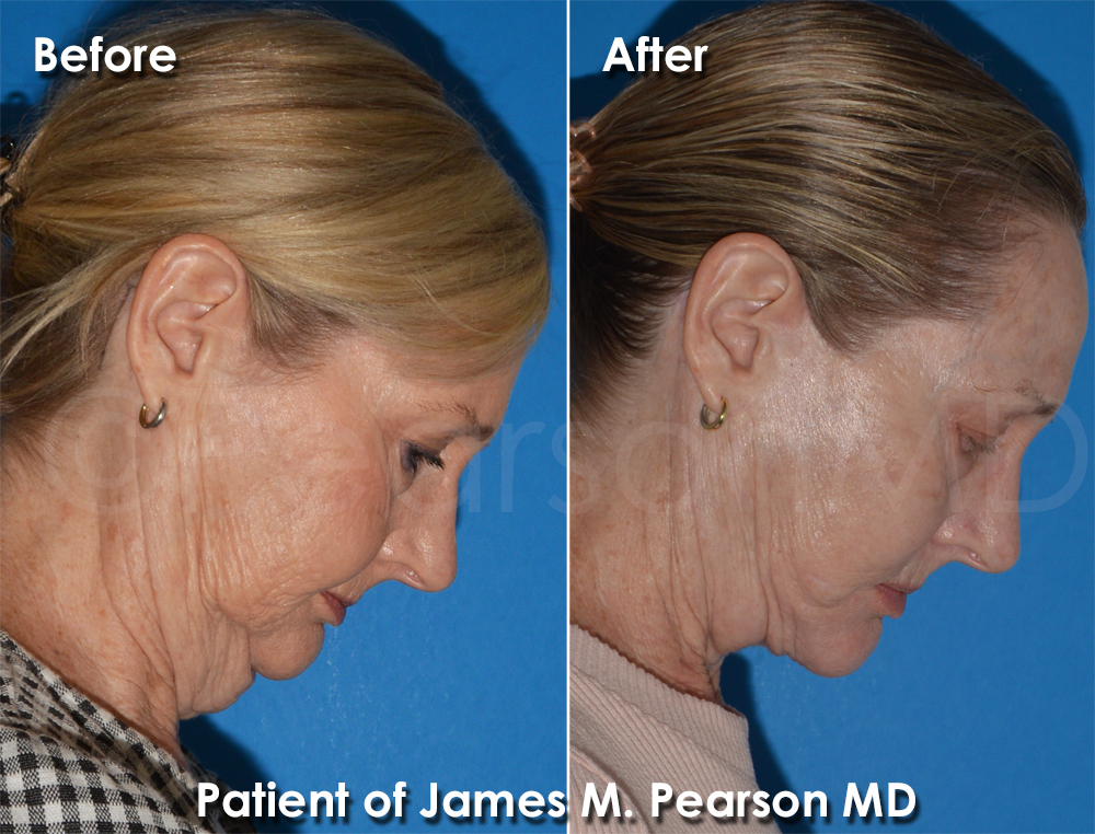Pearson Plastic Surgery
