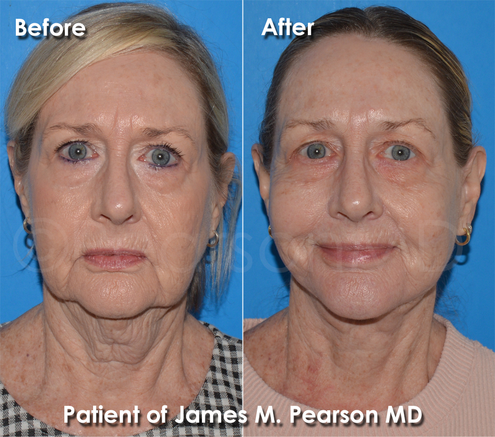 Dr. Pearson Plastic Surgeon