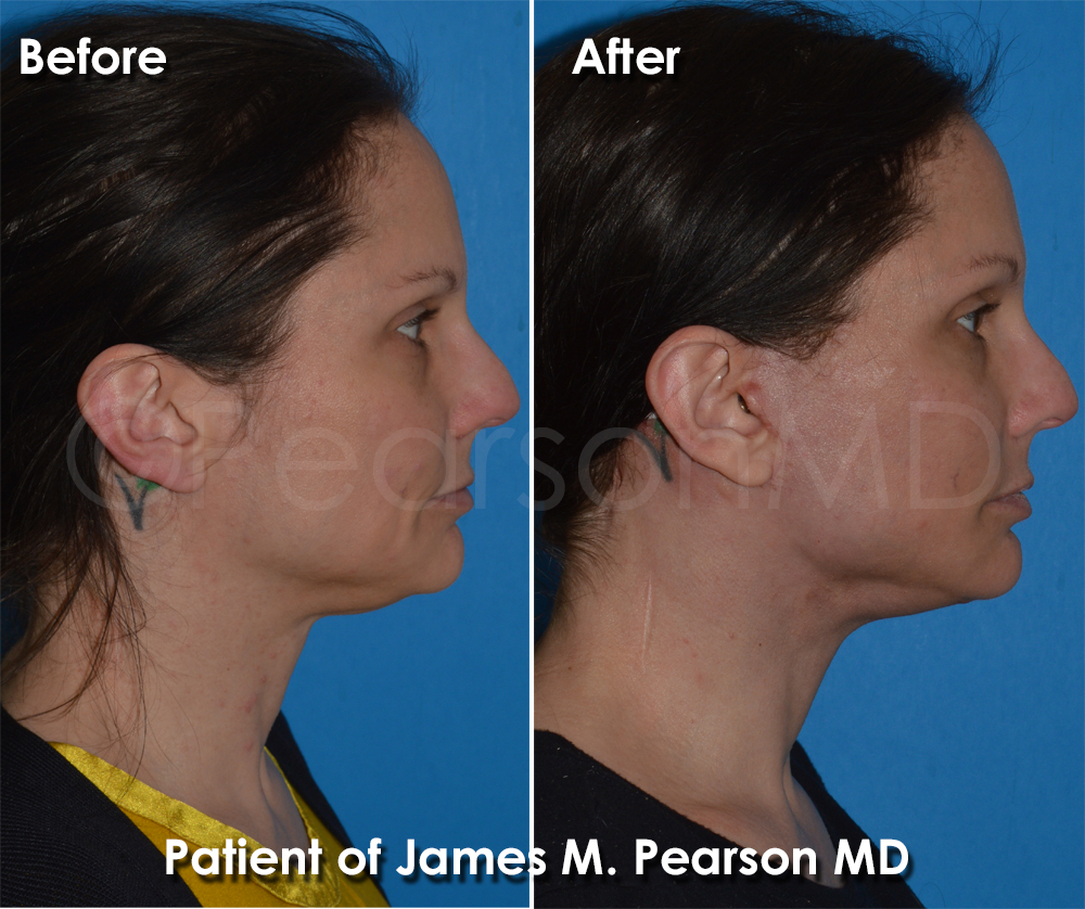 Pearson Plastic Surgery
