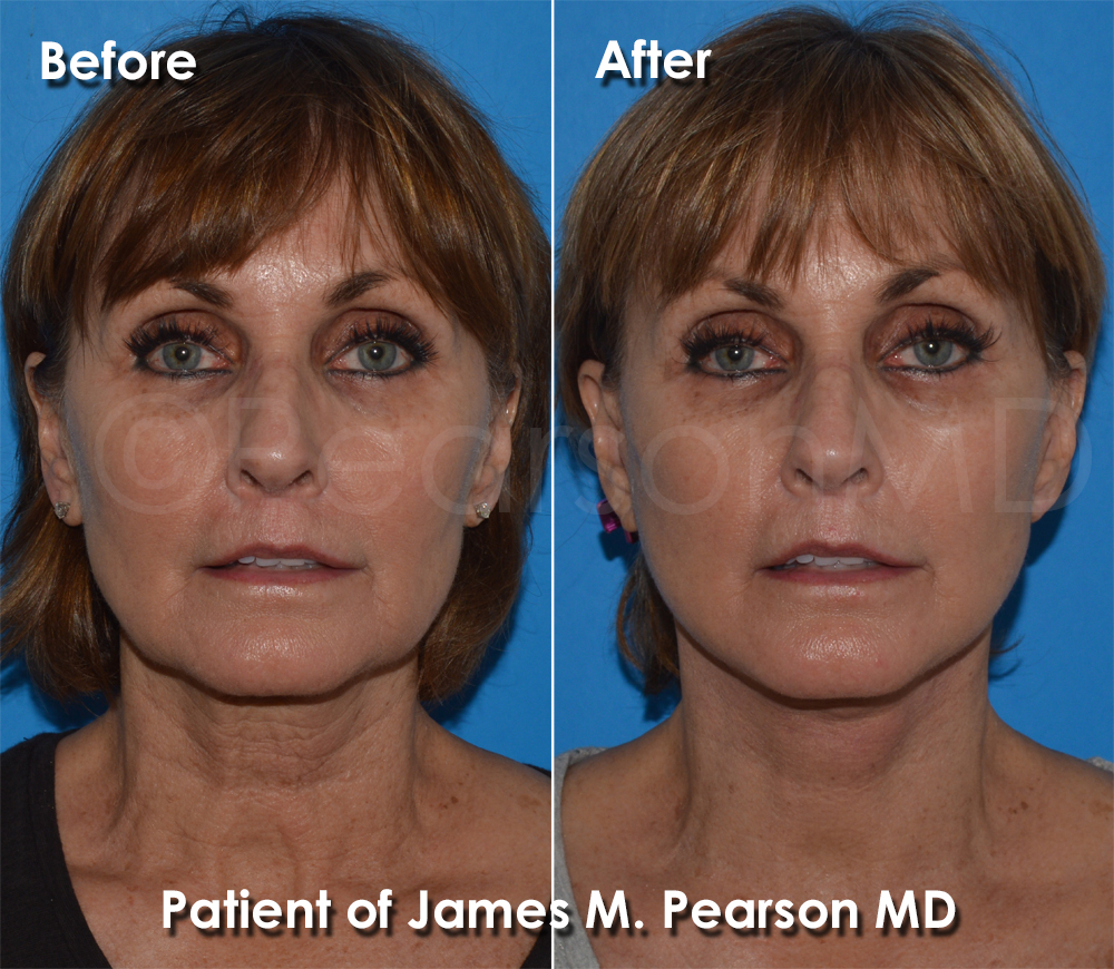 Pearson Plastic Surgery