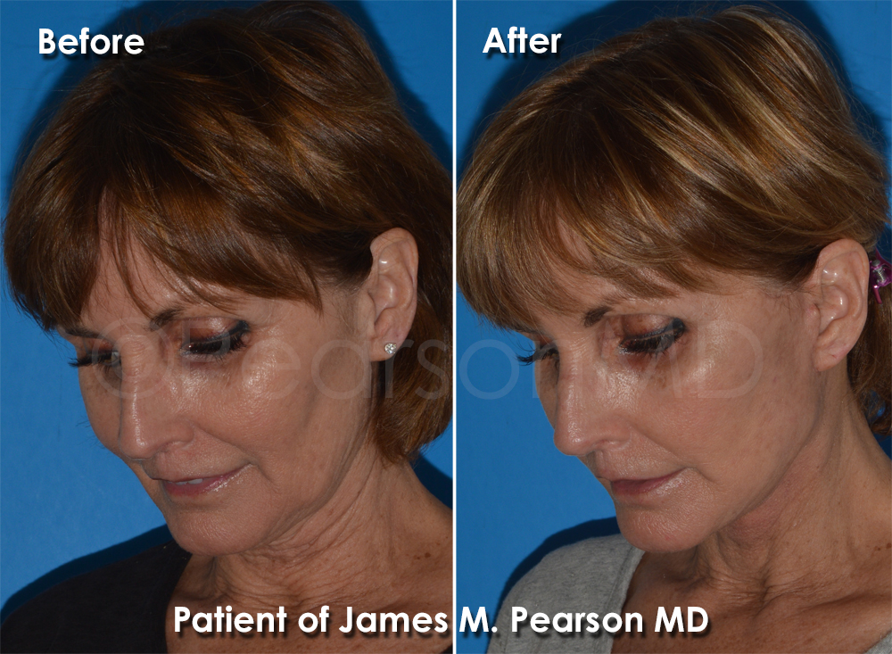 Pearson Plastic Surgery