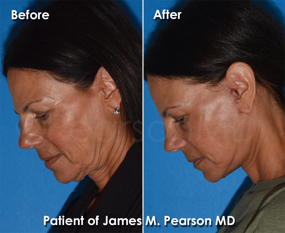 Pearson Plastic Surgery