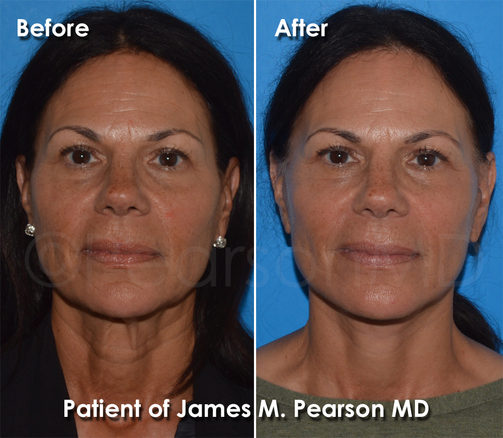Pearson Plastic Surgery