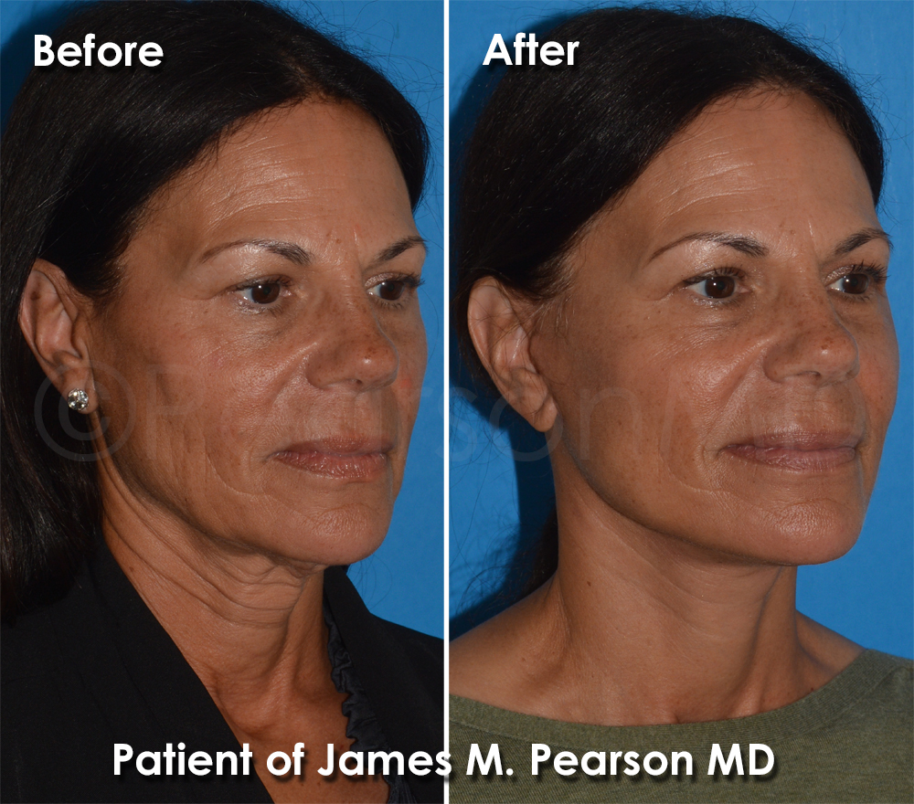 Pearson Plastic Surgery