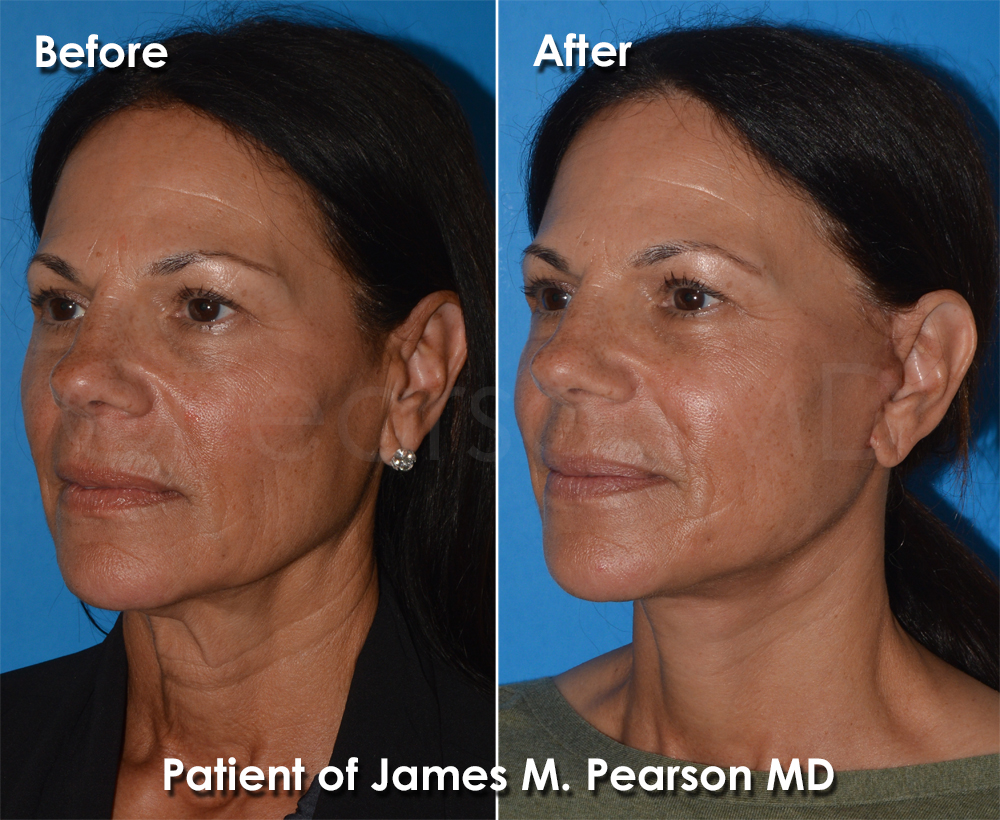 Pearson Plastic Surgery