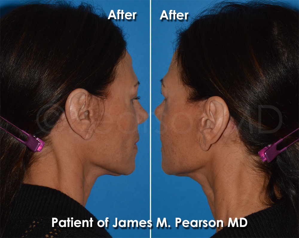 Pearson Plastic Surgery