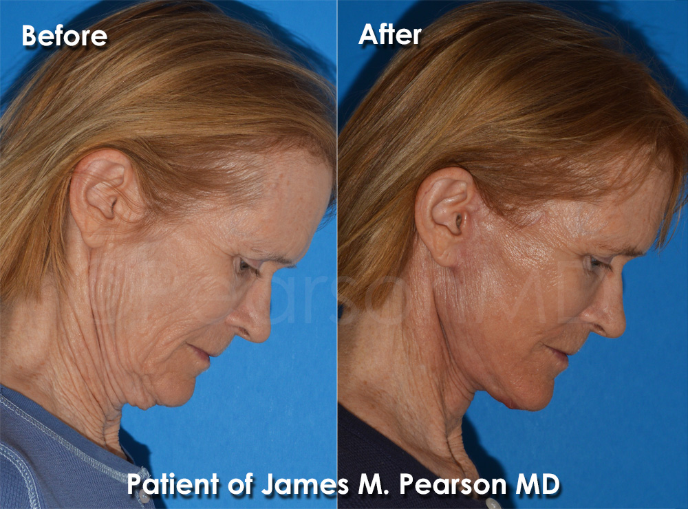 Dr. Pearson Plastic Surgeon
