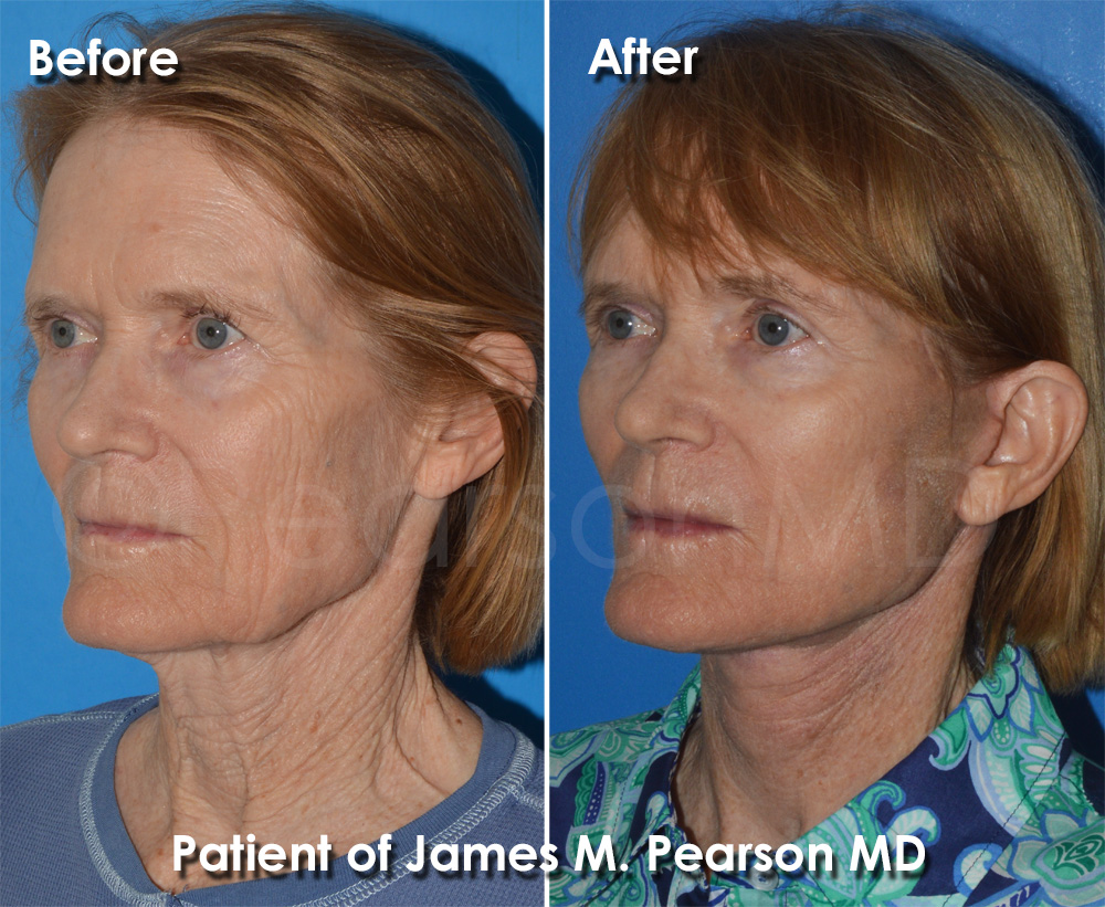 Pearson Plastic Surgery
