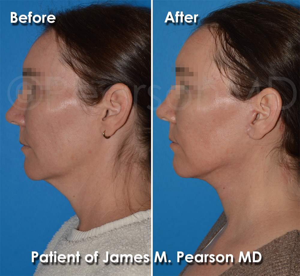 Dr. Pearson Plastic Surgeon
