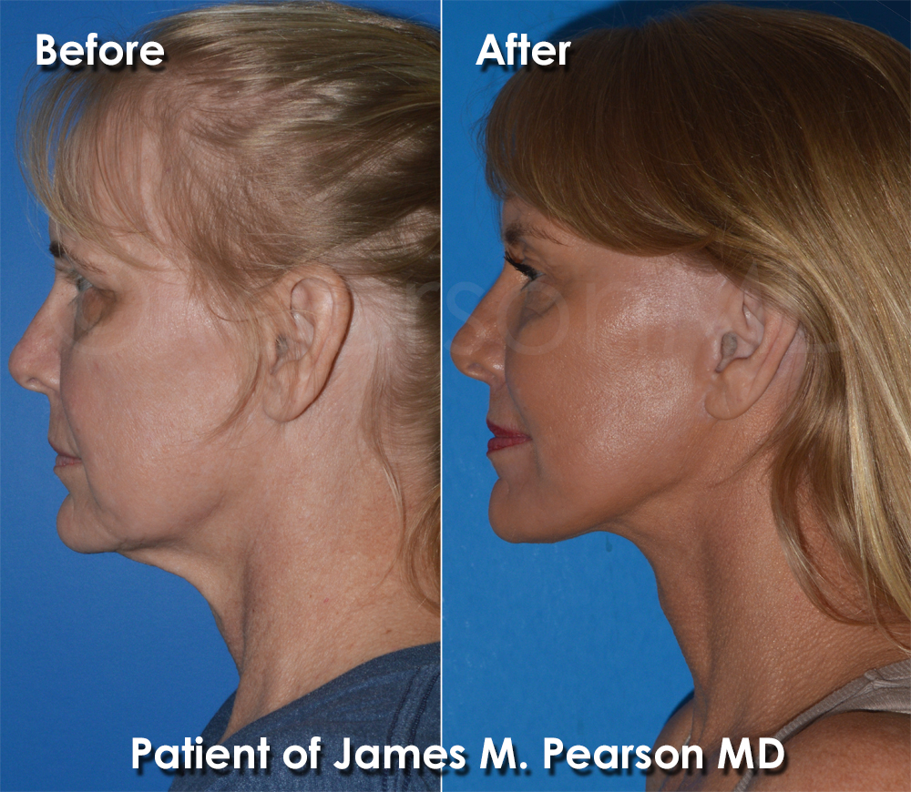 Dr. Pearson Plastic Surgeon