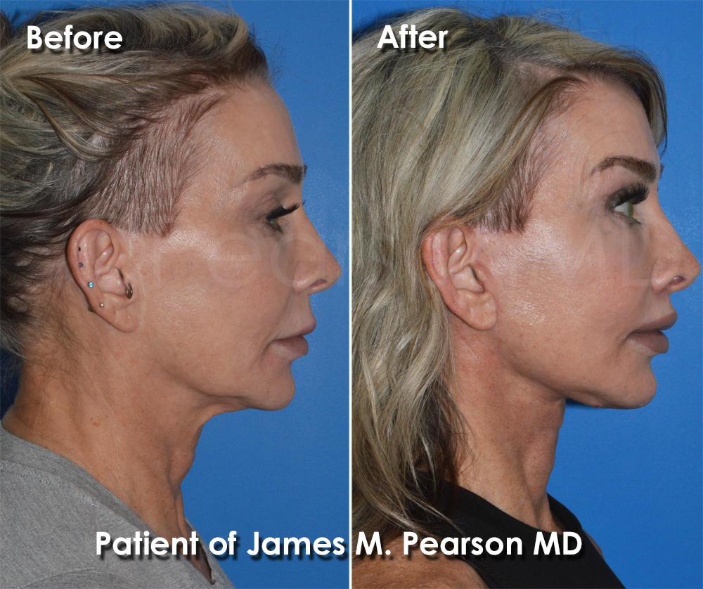Dr. Pearson Plastic Surgeon