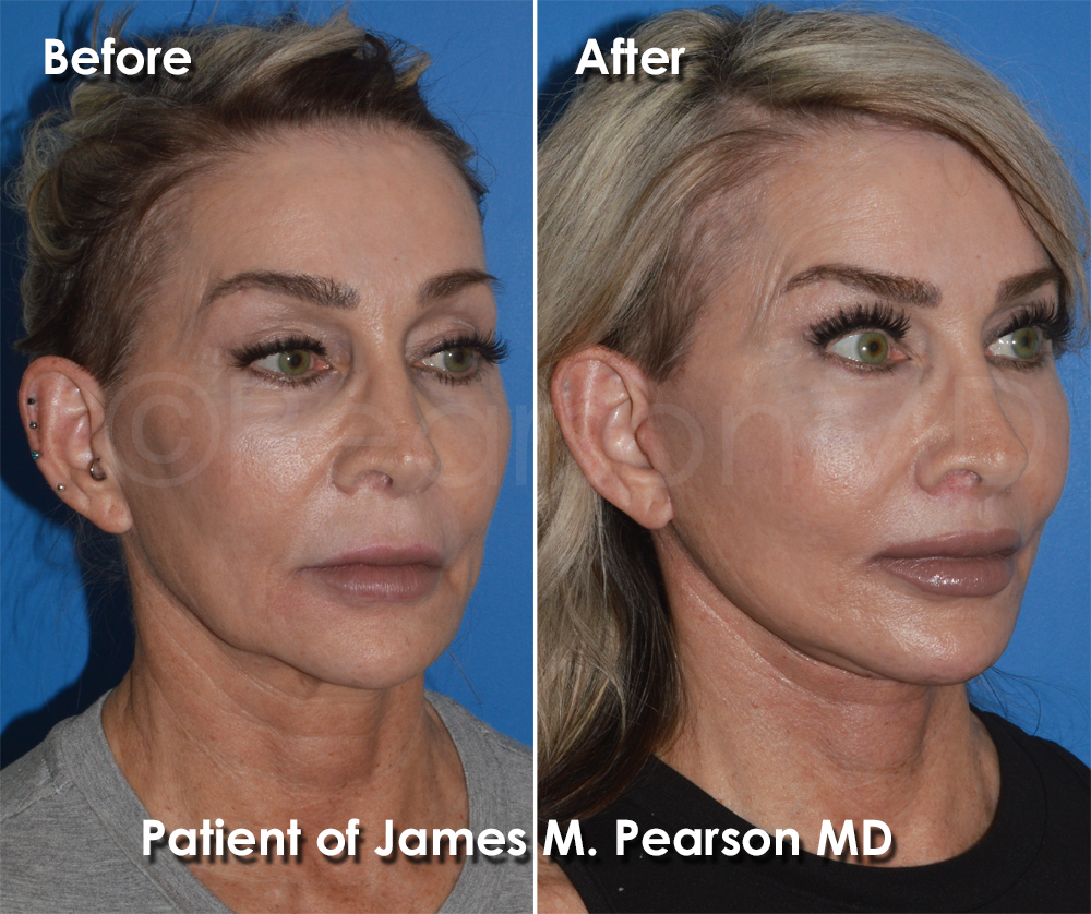 Pearson Plastic Surgery