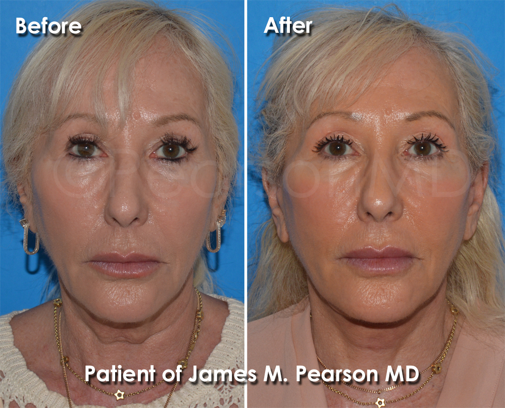 Pearson Plastic Surgery
