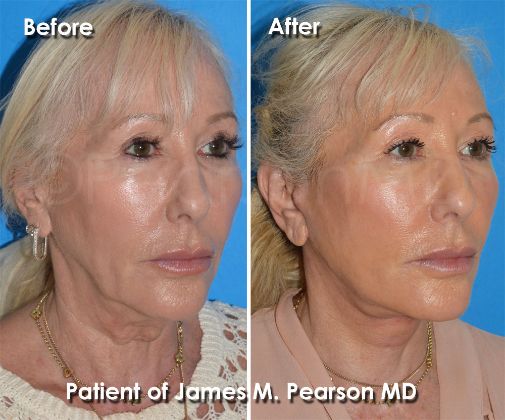 Pearson Plastic Surgery