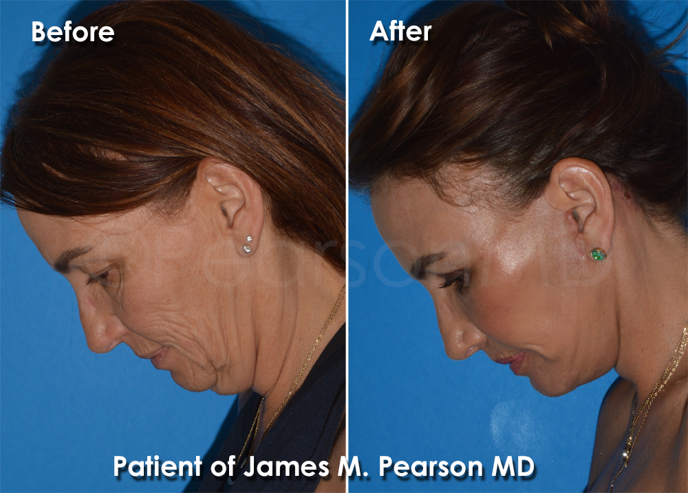 Pearson Plastic Surgery