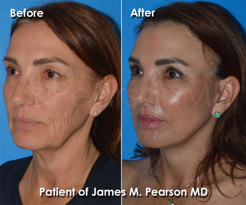 Pearson Plastic Surgery