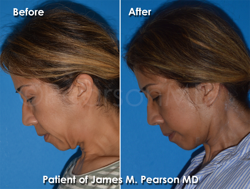 Dr. Pearson Plastic Surgeon