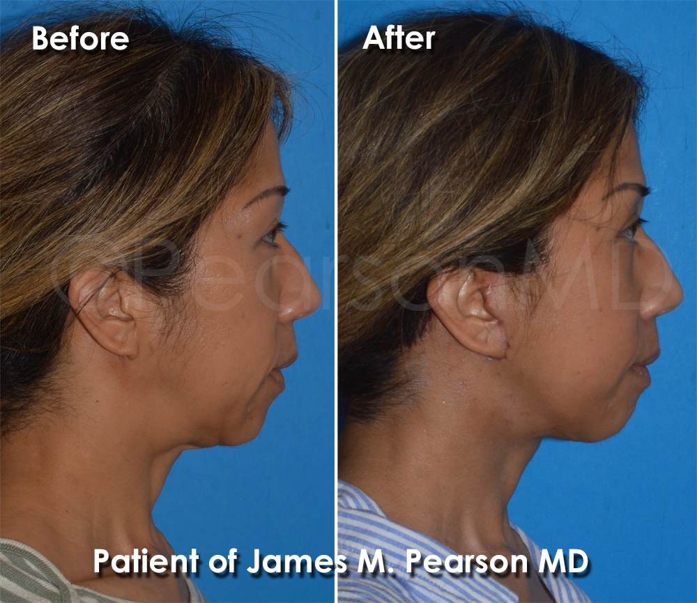 Dr. Pearson Plastic Surgeon