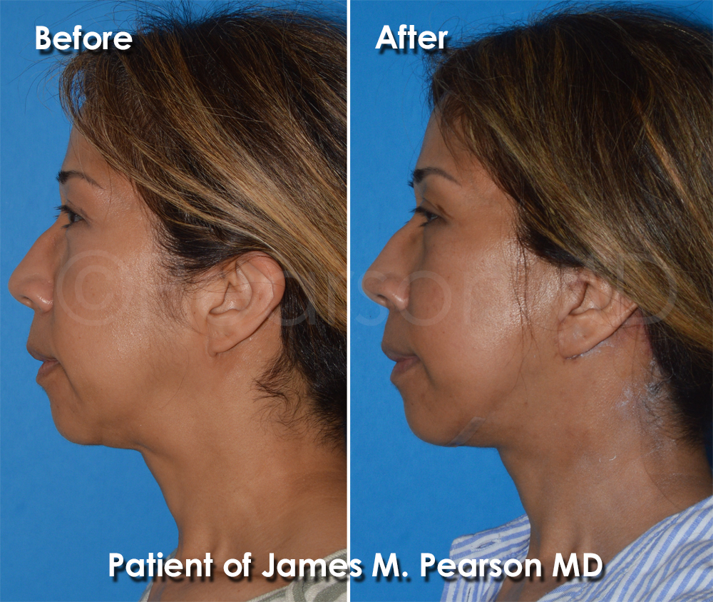 Pearson Plastic Surgery