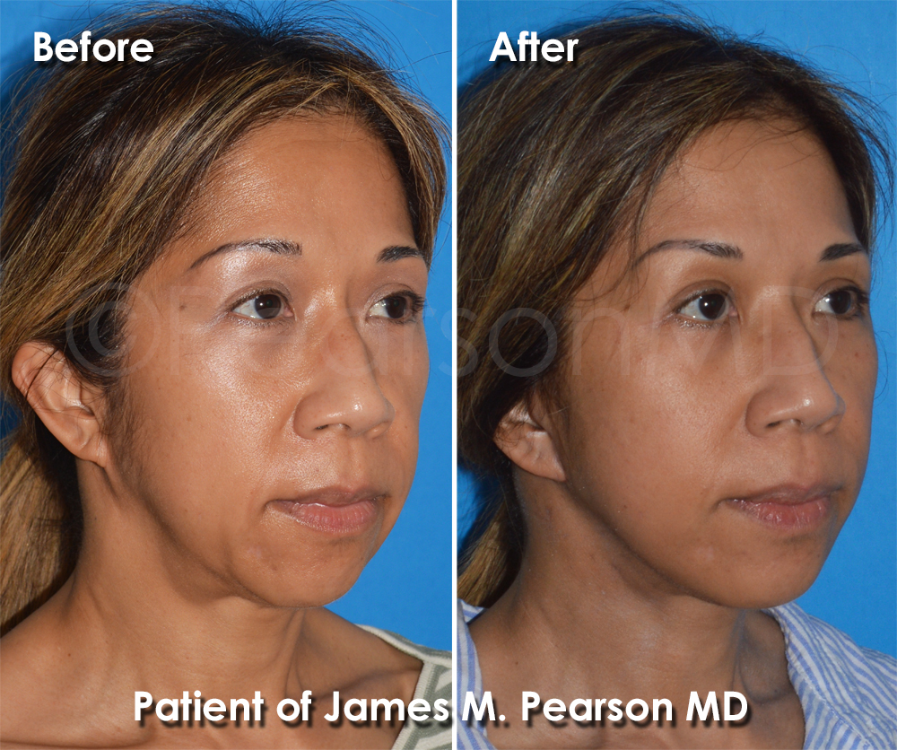 Pearson Plastic Surgery