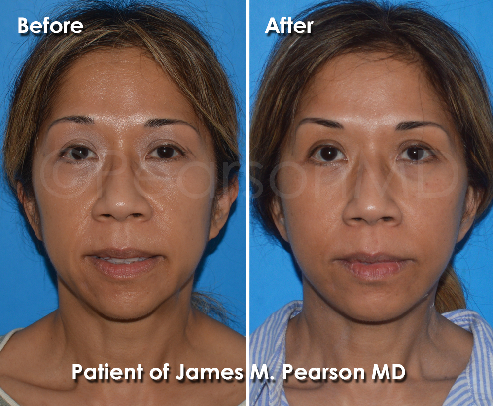 Pearson Plastic Surgery