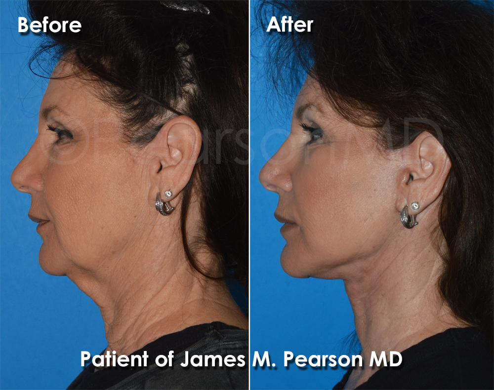 Dr. Pearson Plastic Surgeon