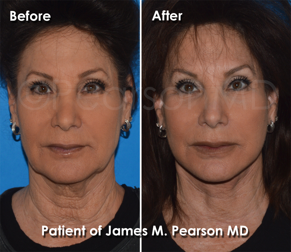 Pearson Plastic Surgery