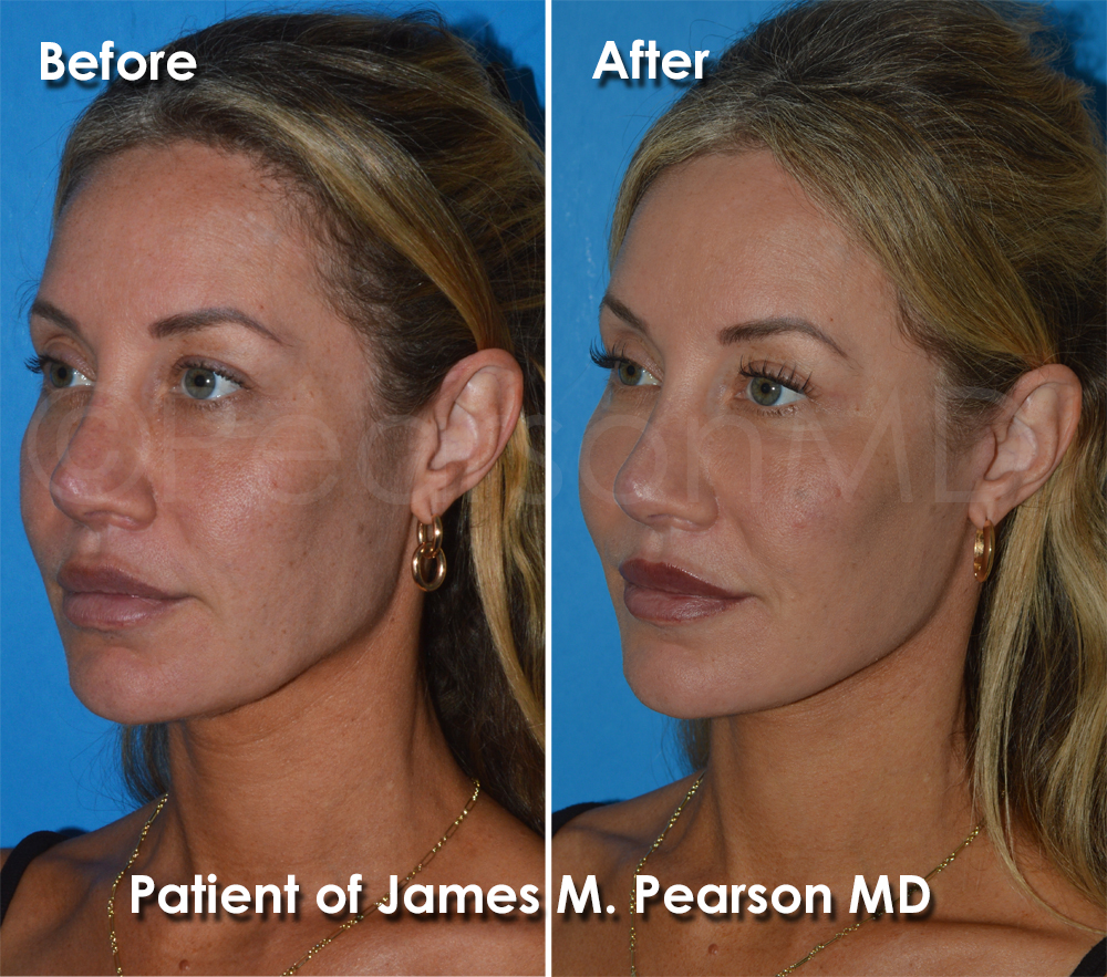 Pearson Plastic Surgery