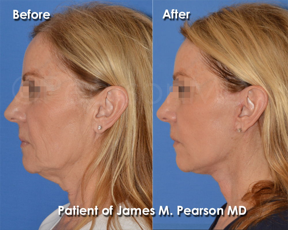 Photos Pearson Facelift