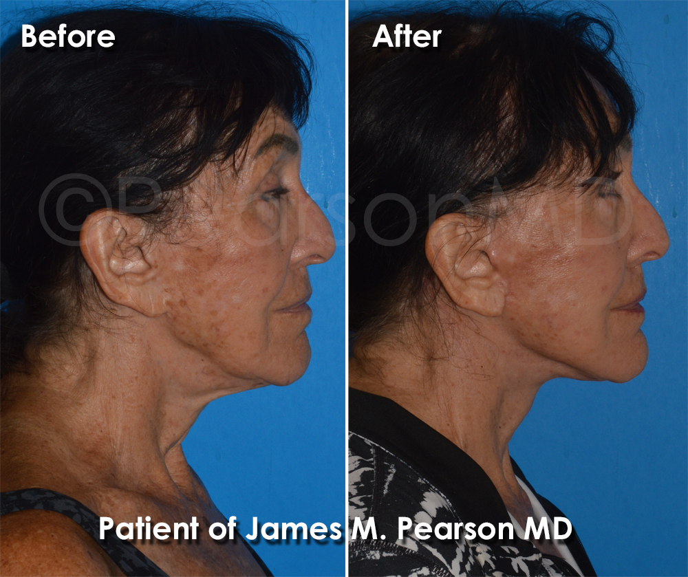 Dr. Pearson Plastic Surgeon