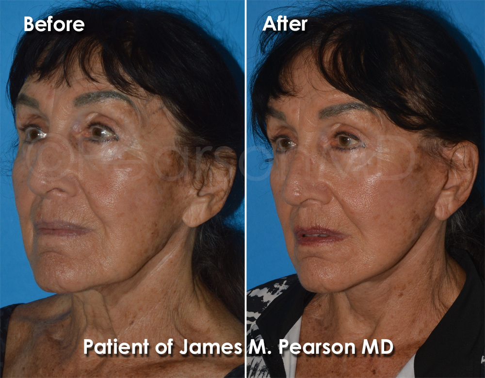 Pearson Plastic Surgery