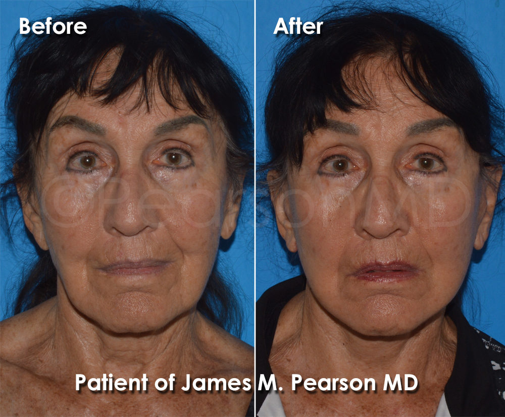 Pearson Plastic Surgery
