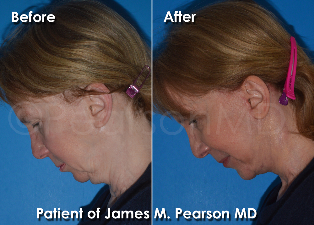 Pearson Plastic Surgery