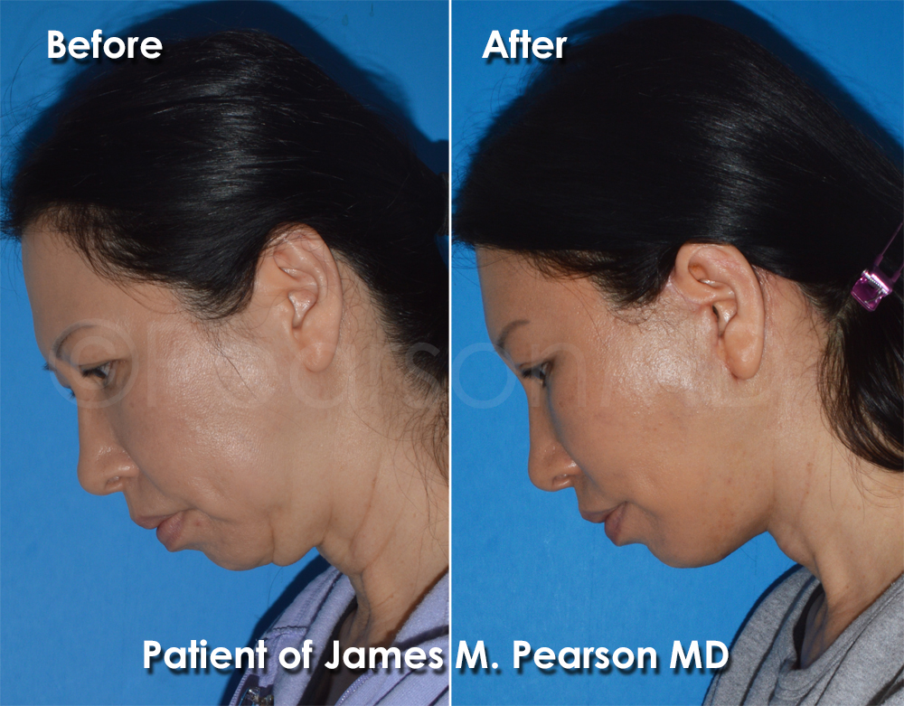 Dr. Pearson Plastic Surgeon