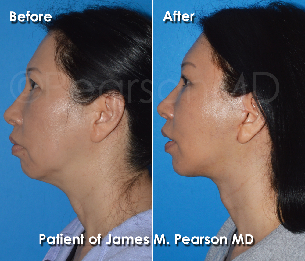 Pearson Plastic Surgery