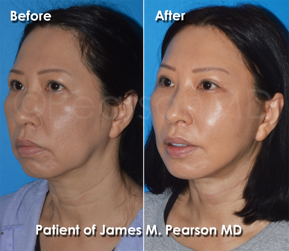 Pearson Plastic Surgery