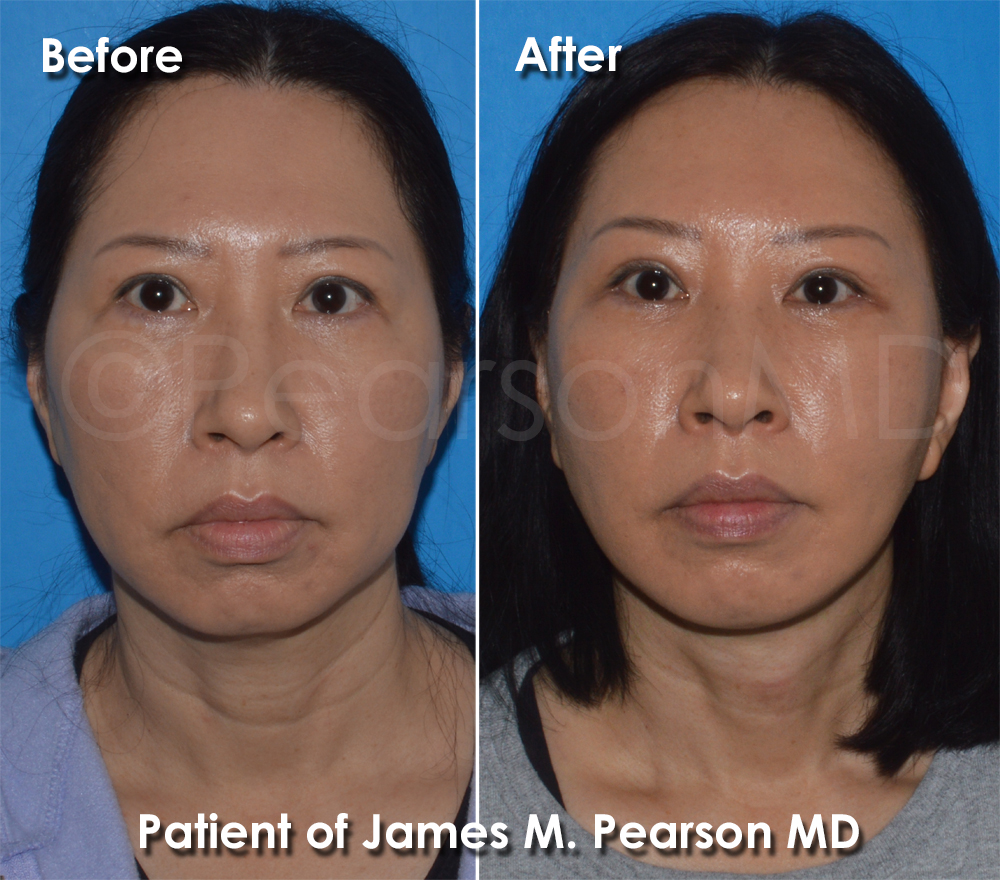 Pearson Plastic Surgery