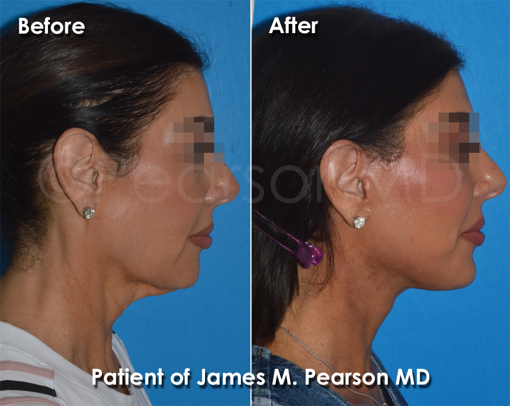 Dr. Pearson Plastic Surgeon