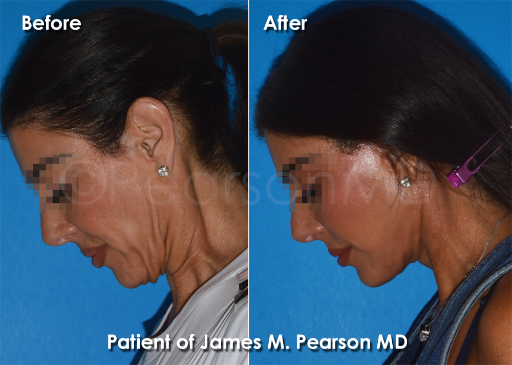 Pearson Plastic Surgery