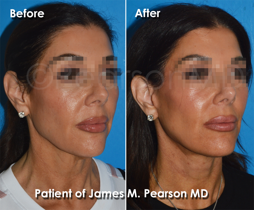 Pearson Plastic Surgery