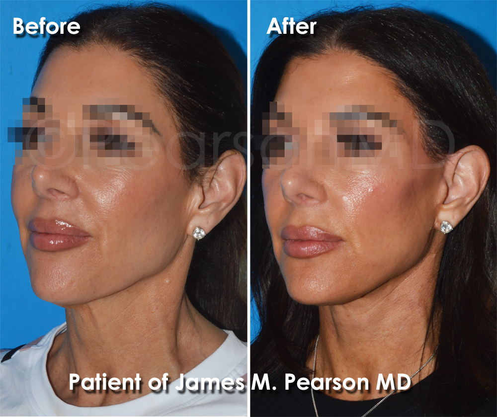 Pearson Plastic Surgery