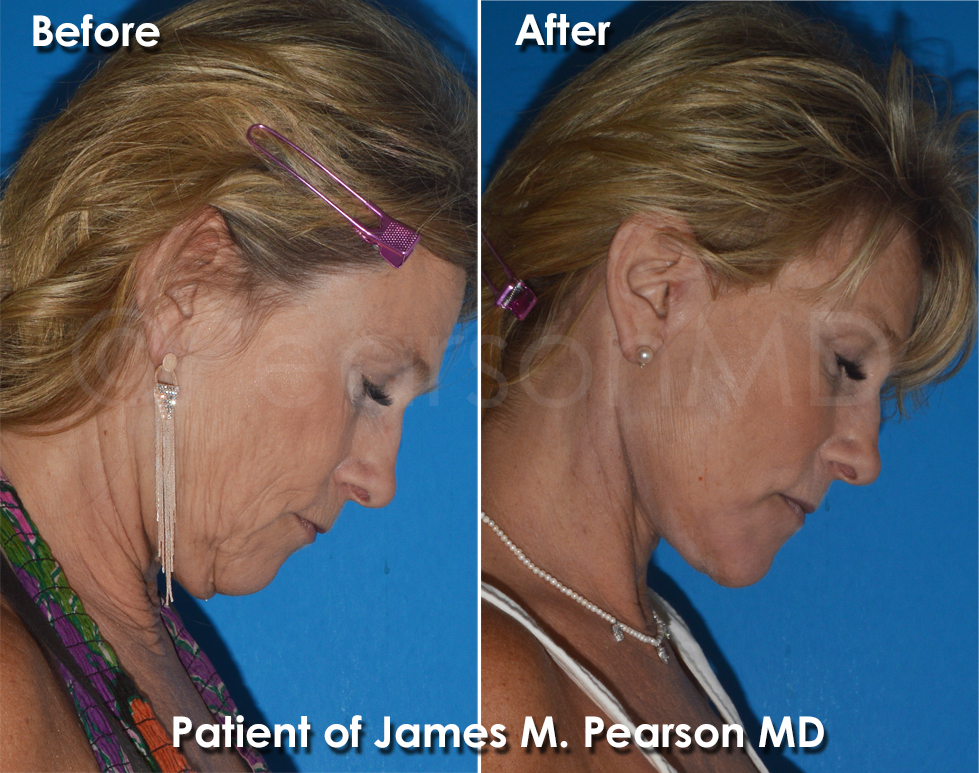 Pearson Plastic Surgery